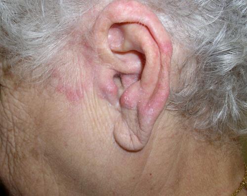 tinea1