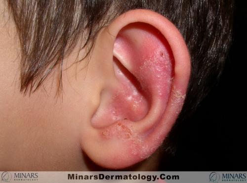 tinea 01 A