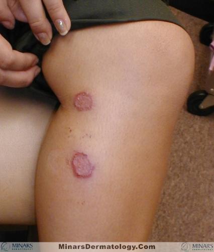 tinea 02 A