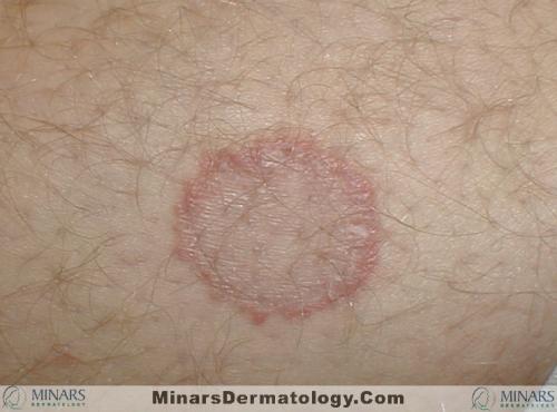 tinea 03 A