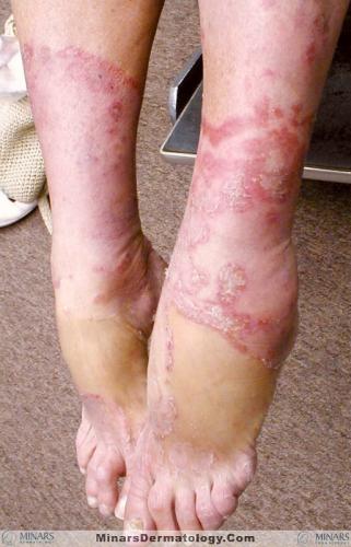 tinea 04 A