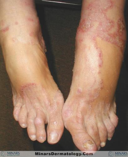 tinea 05 A