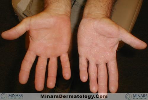 tinea 06 A