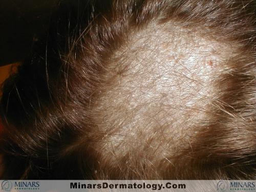 tinea capitis 01 A