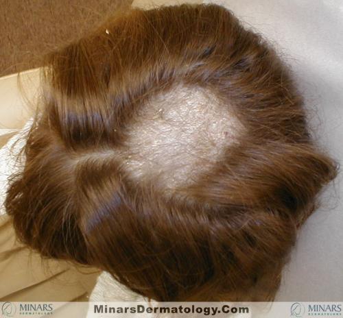 tinea capitis A