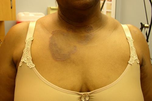 tinea corporis (1)