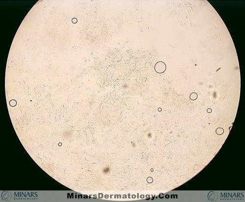 tinea versicolor