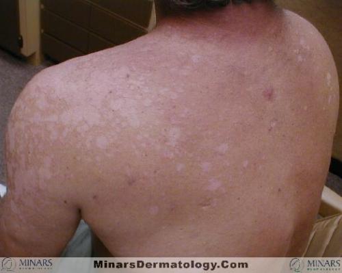 tinea versicolor 01 A