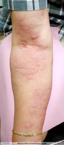 urticaria A