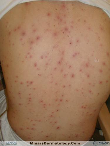 varicella 2 A