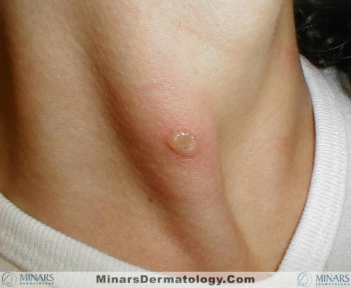 varicella A