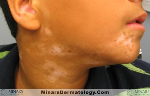 vitiligo A
