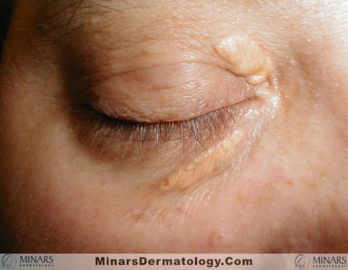 xanthelasma 01 A